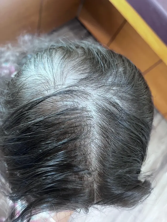 Female Pattern Baldness case 3 before treatment
